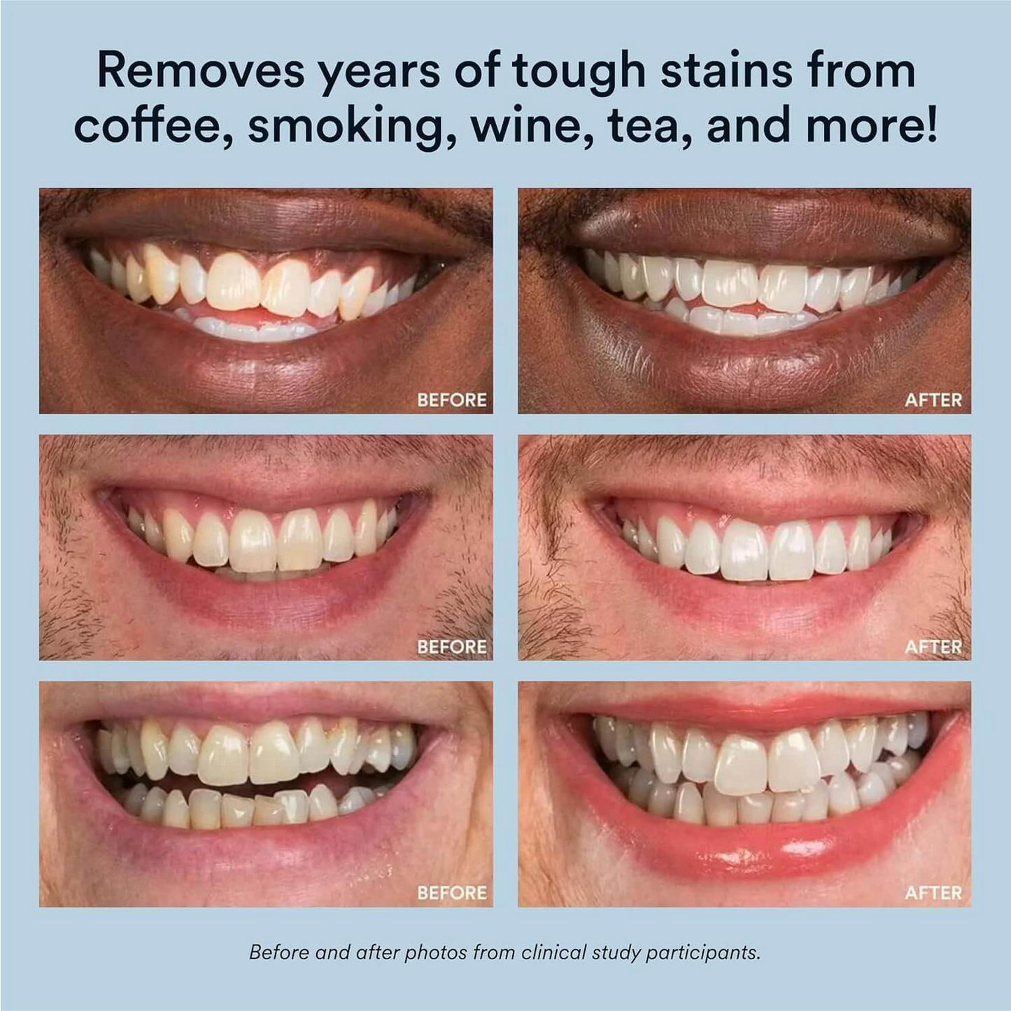 Auraglow Teeth Whitening Kit